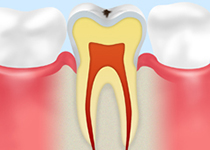 CO：初期の虫歯（脱灰）